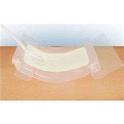 Avelle NPWT Sterile Dressing 16cm x 16cm B5